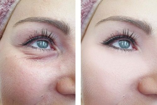 Understanding Laser Resurfacing for Eye Bags: How It Works, Benefits and Recovery