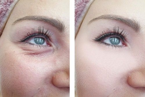 Laser Resurfacing for Eye Bags: Complete Guide to Treatment, Benefits, and Recovery