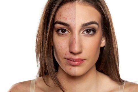 Top Acne Scar Removal: Your Guide to Smoother Skin